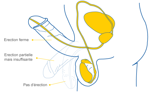 Viagra : la pilule bleue pour les pannes d'érection